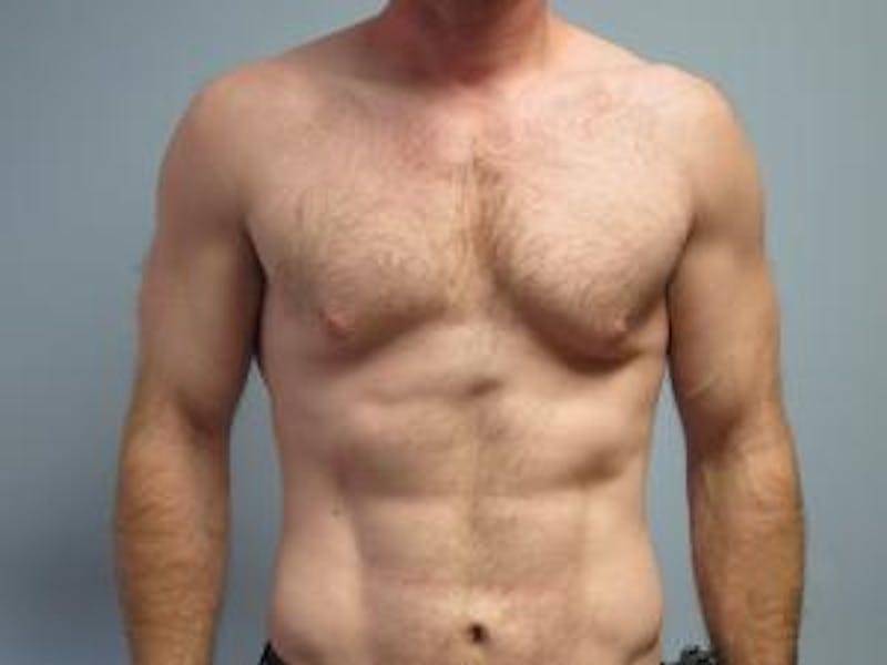 Gynecomastia Before & After Gallery - Patient 166148 - Image 1