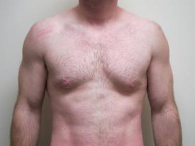 Gynecomastia Before & After Gallery - Patient 166148 - Image 2