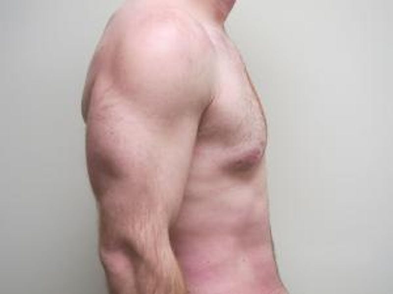 Gynecomastia Before & After Gallery - Patient 166148 - Image 4