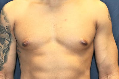 Gynecomastia Before & After Gallery - Patient 197950 - Image 1