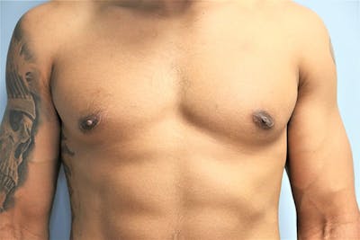 Gynecomastia Before & After Gallery - Patient 197950 - Image 2