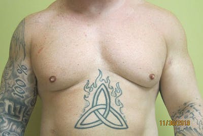 Gynecomastia Before & After Gallery - Patient 199144 - Image 1