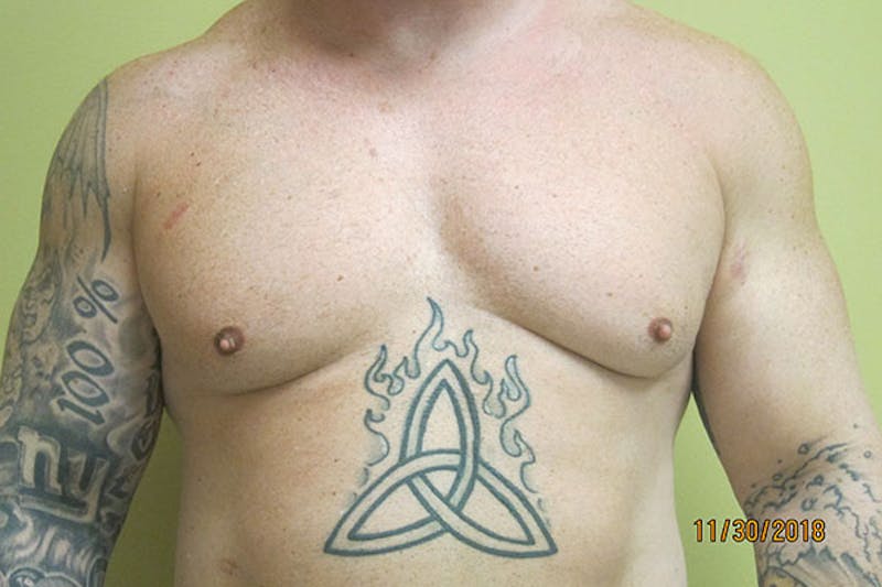 Gynecomastia Before & After Gallery - Patient 199144 - Image 1