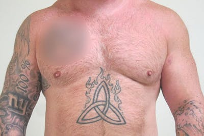 Gynecomastia Before & After Gallery - Patient 199144 - Image 2