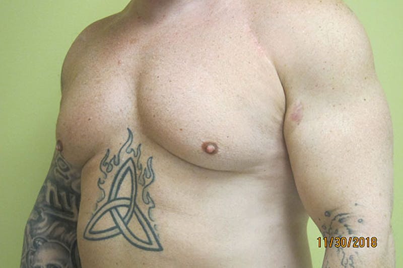 Gynecomastia Before & After Gallery - Patient 199144 - Image 3