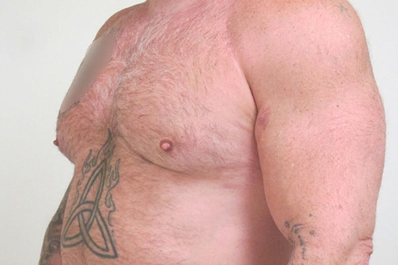 Gynecomastia Before & After Gallery - Patient 199144 - Image 4