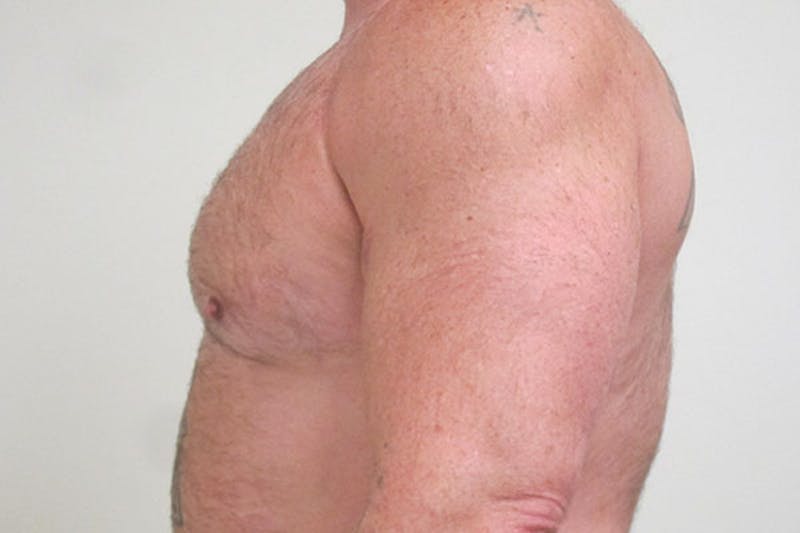 Gynecomastia Before & After Gallery - Patient 199144 - Image 6