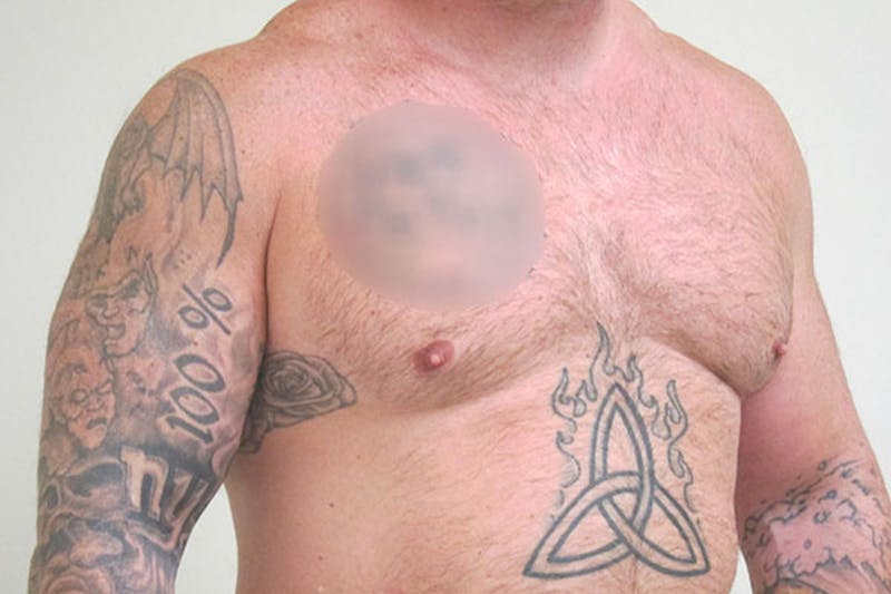 Gynecomastia Before & After Gallery - Patient 199144 - Image 8