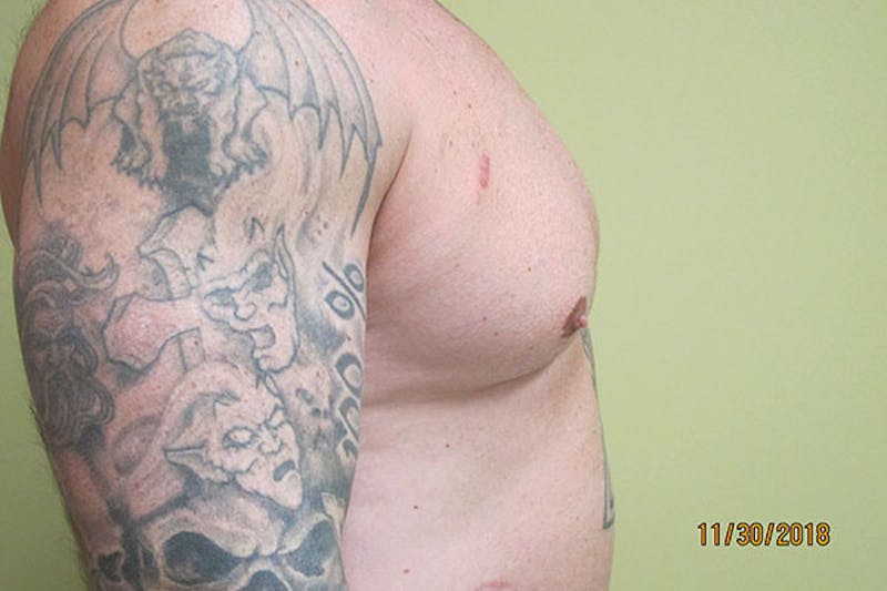 Gynecomastia Before & After Gallery - Patient 199144 - Image 9