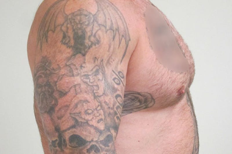 Gynecomastia Before & After Gallery - Patient 199144 - Image 10