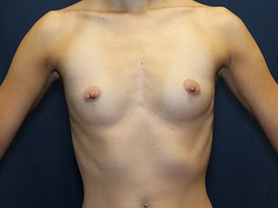 Augmentation (Enlargement) Before & After Gallery - Patient 227746 - Image 1