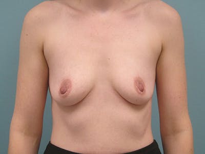 Augmentation (Enlargement) Before & After Gallery - Patient 785566 - Image 1