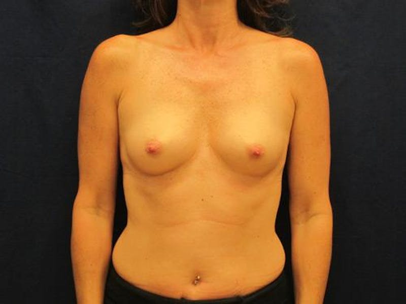 Augmentation (Enlargement) Before & After Gallery - Patient 292214 - Image 1
