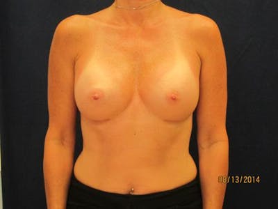Augmentation (Enlargement) Before & After Gallery - Patient 292214 - Image 2