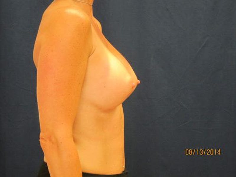 Augmentation (Enlargement) Before & After Gallery - Patient 292214 - Image 6