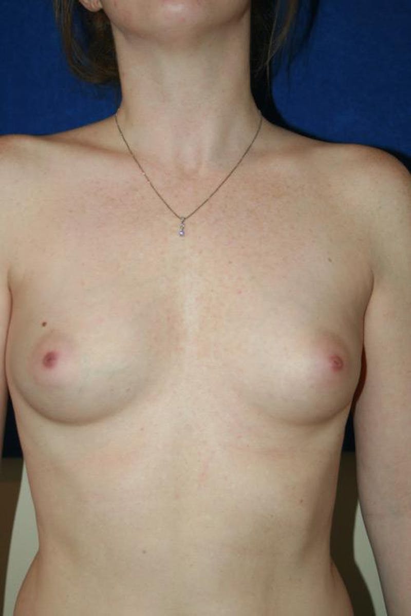 Augmentation (Enlargement) Before & After Gallery - Patient 726208 - Image 1