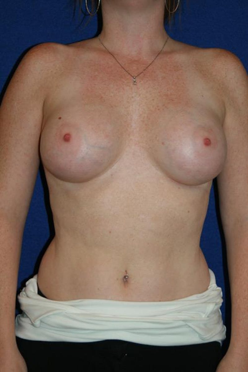 Augmentation (Enlargement) Before & After Gallery - Patient 726208 - Image 2