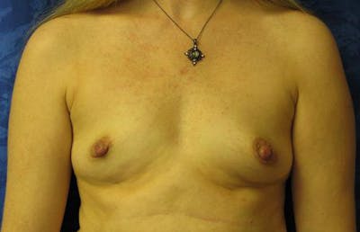 Augmentation (Enlargement) Before & After Gallery - Patient 919485 - Image 1