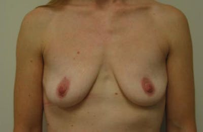 Augmentation (Enlargement) Before & After Gallery - Patient 237080 - Image 1