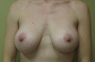 Augmentation (Enlargement) Before & After Gallery - Patient 237080 - Image 2