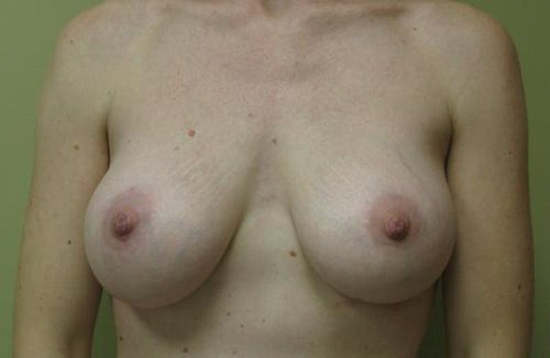 Augmentation (Enlargement) Before & After Gallery - Patient 237080 - Image 2