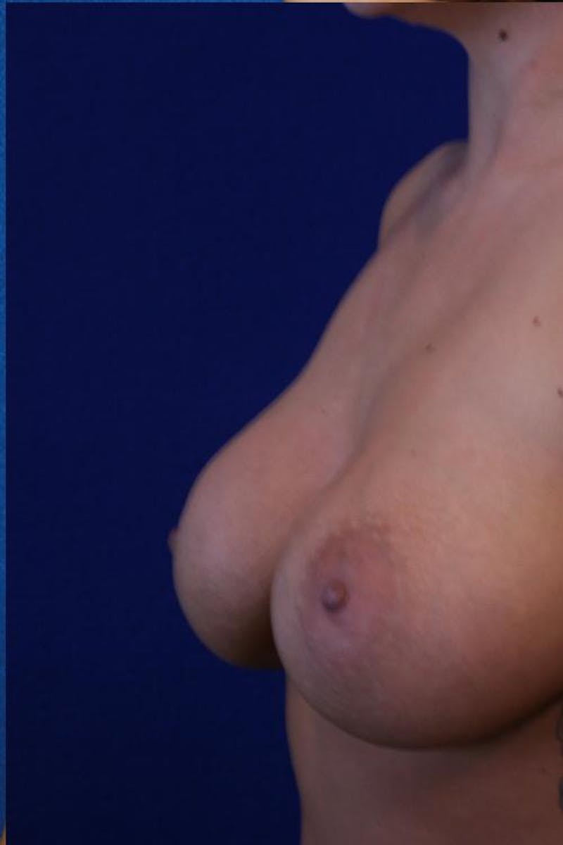 Augmentation (Enlargement) Before & After Gallery - Patient 267900 - Image 6