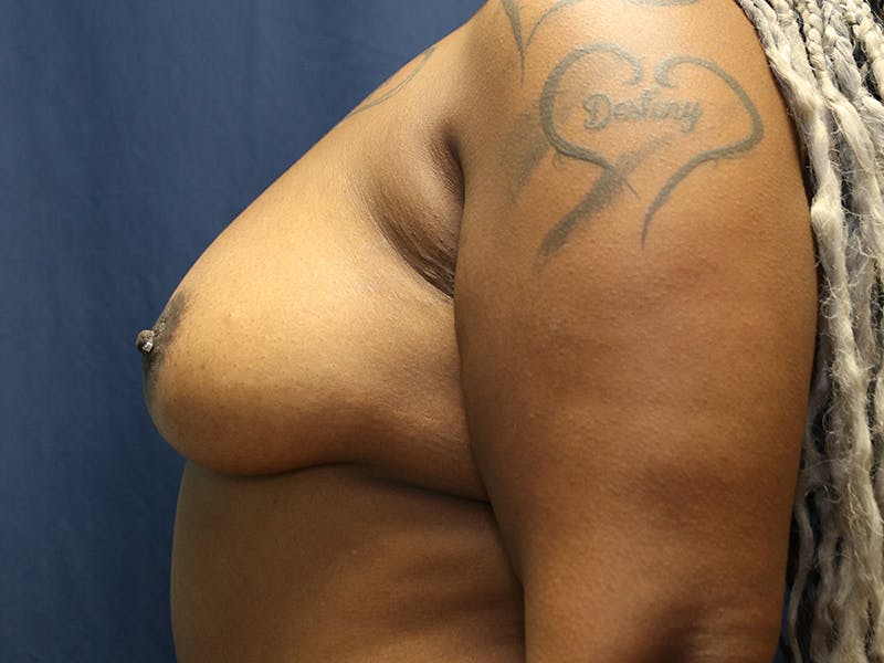 Augmentation (Enlargement) Before & After Gallery - Patient 964590 - Image 5