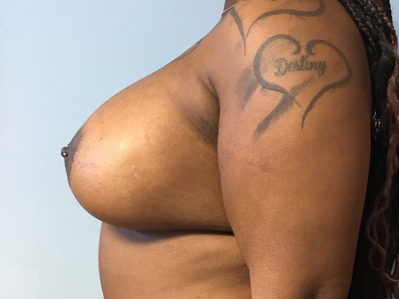 Augmentation (Enlargement) Before & After Gallery - Patient 964590 - Image 6