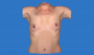 Augmentation (Enlargement) Before & After Gallery - Patient 209523 - Image 1