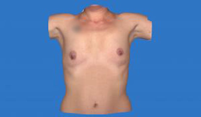 Augmentation (Enlargement) Before & After Gallery - Patient 209523 - Image 1