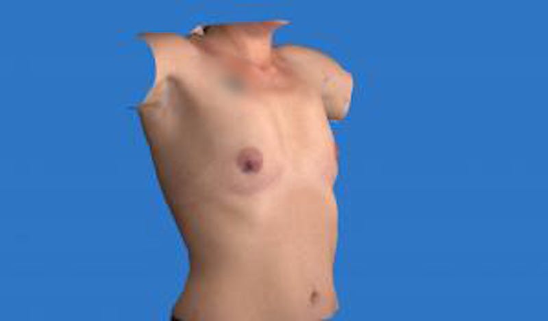 Augmentation (Enlargement) Before & After Gallery - Patient 209523 - Image 3