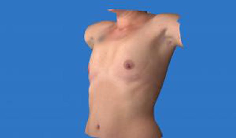 Augmentation (Enlargement) Before & After Gallery - Patient 209523 - Image 5