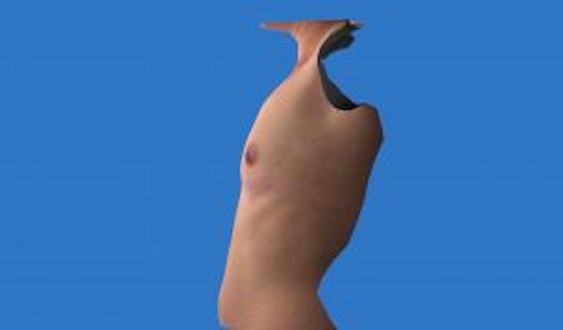 Augmentation (Enlargement) Before & After Gallery - Patient 209523 - Image 7