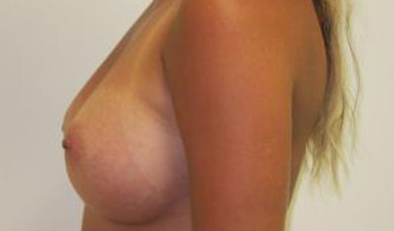 Augmentation (Enlargement) Before & After Gallery - Patient 209523 - Image 8