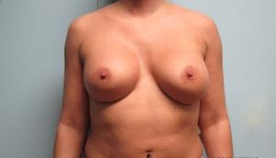 Augmentation (Enlargement) Before & After Gallery - Patient 950064 - Image 2