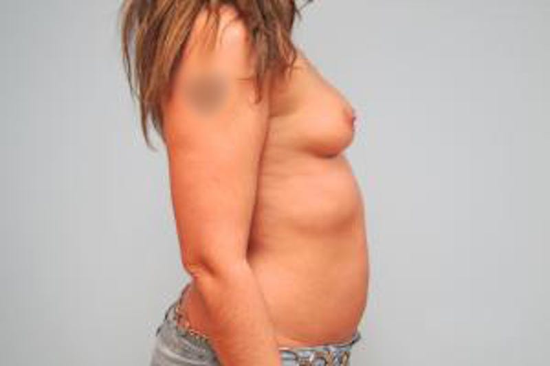 Augmentation (Enlargement) Before & After Gallery - Patient 950064 - Image 5