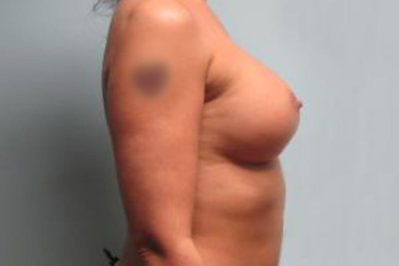 Augmentation (Enlargement) Before & After Gallery - Patient 950064 - Image 6