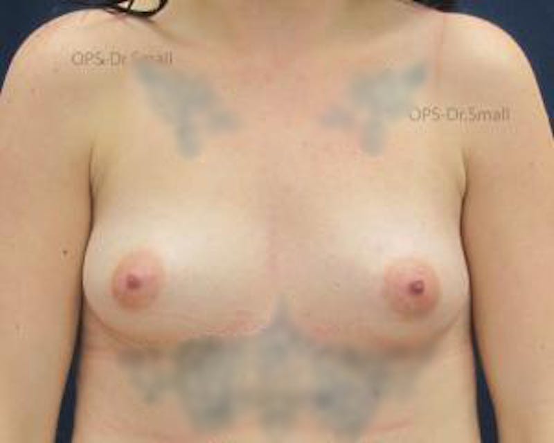 Augmentation (Enlargement) Before & After Gallery - Patient 346790 - Image 1