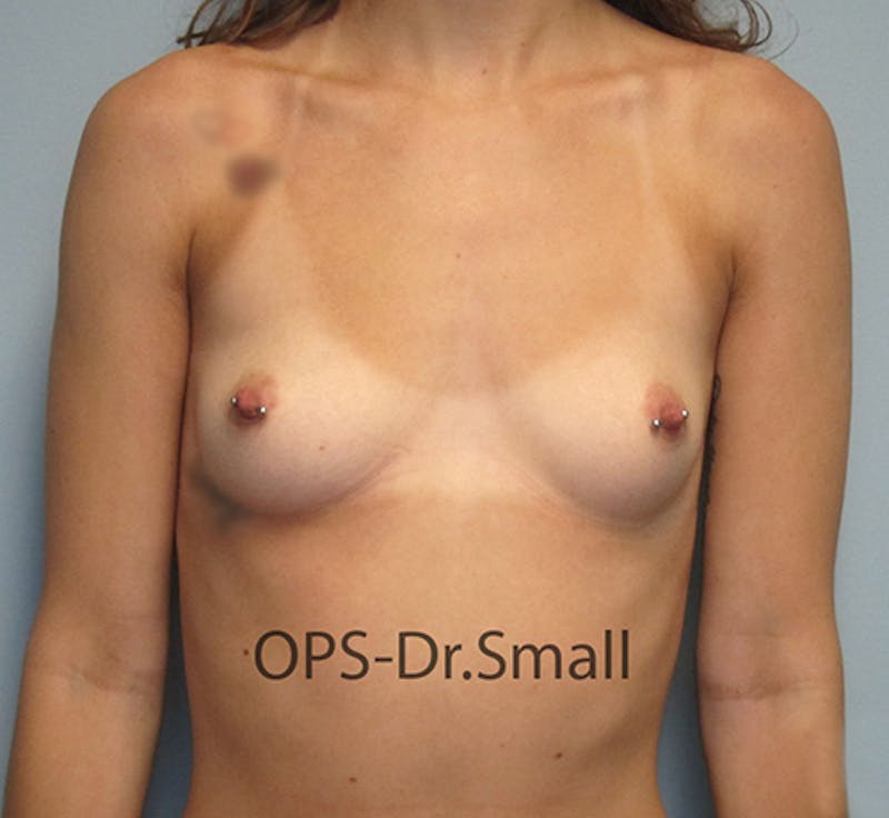Augmentation (Enlargement) Before & After Gallery - Patient 995476 - Image 1