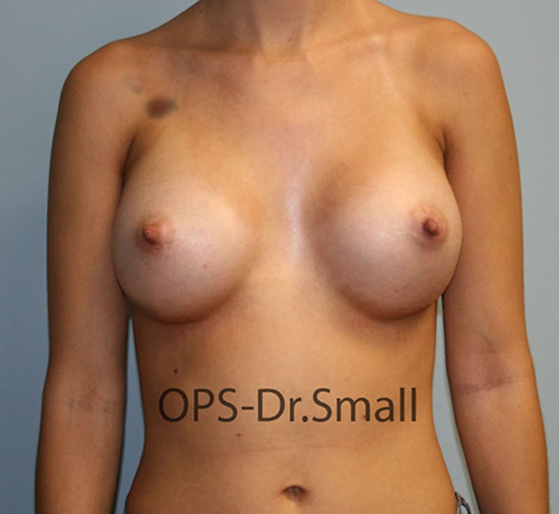 Augmentation (Enlargement) Before & After Gallery - Patient 995476 - Image 2