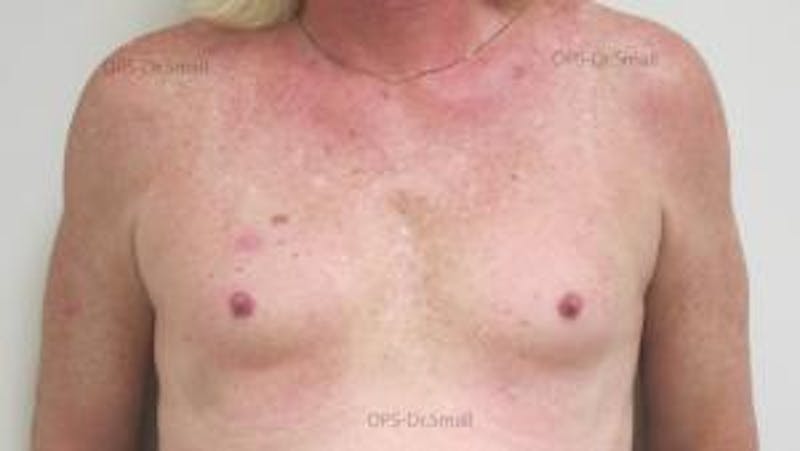 Augmentation (Enlargement) Before & After Gallery - Patient 204926 - Image 1