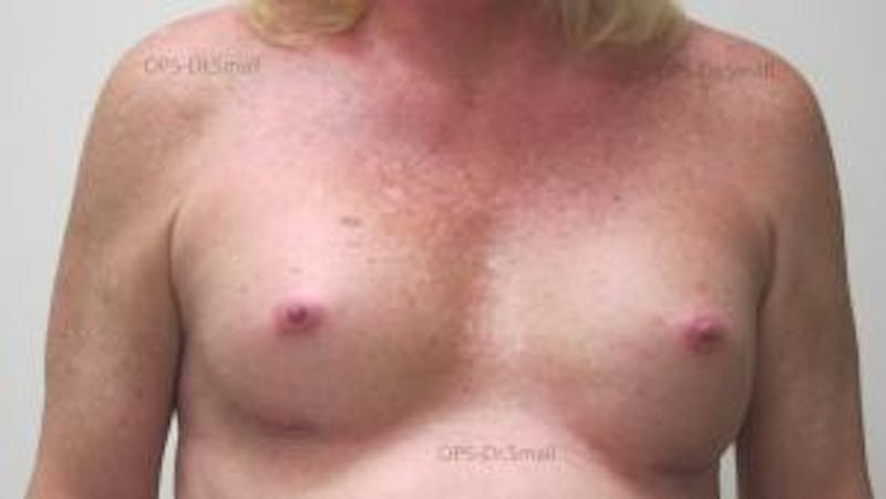 Augmentation (Enlargement) Before & After Gallery - Patient 204926 - Image 2