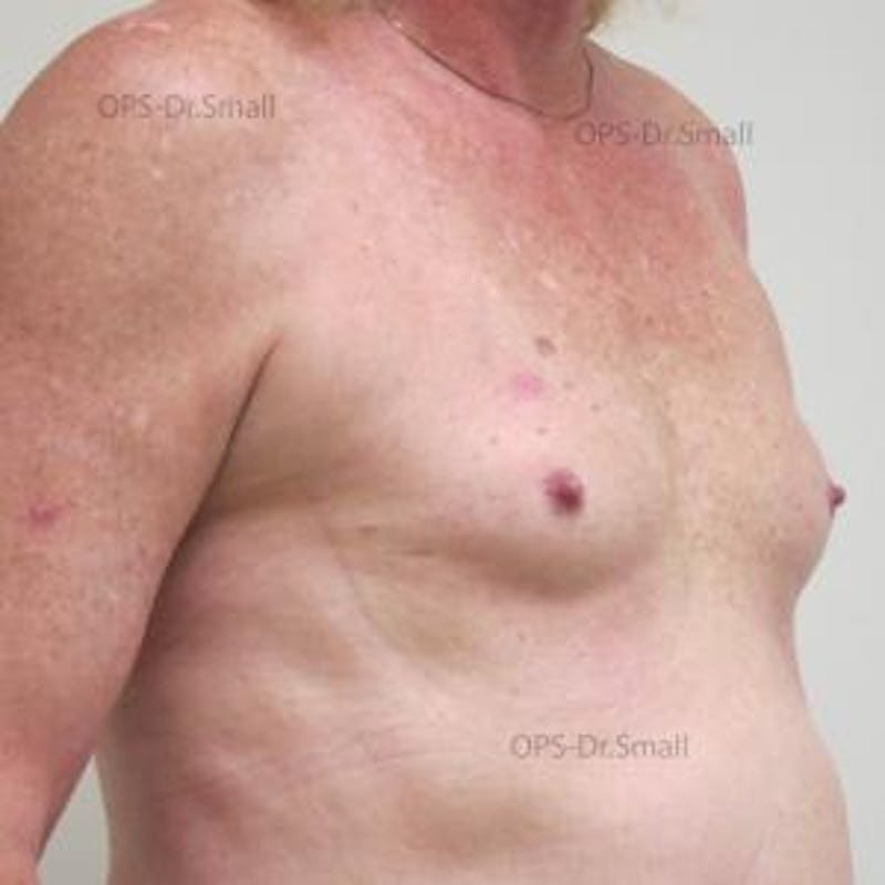 Augmentation (Enlargement) Before & After Gallery - Patient 204926 - Image 3
