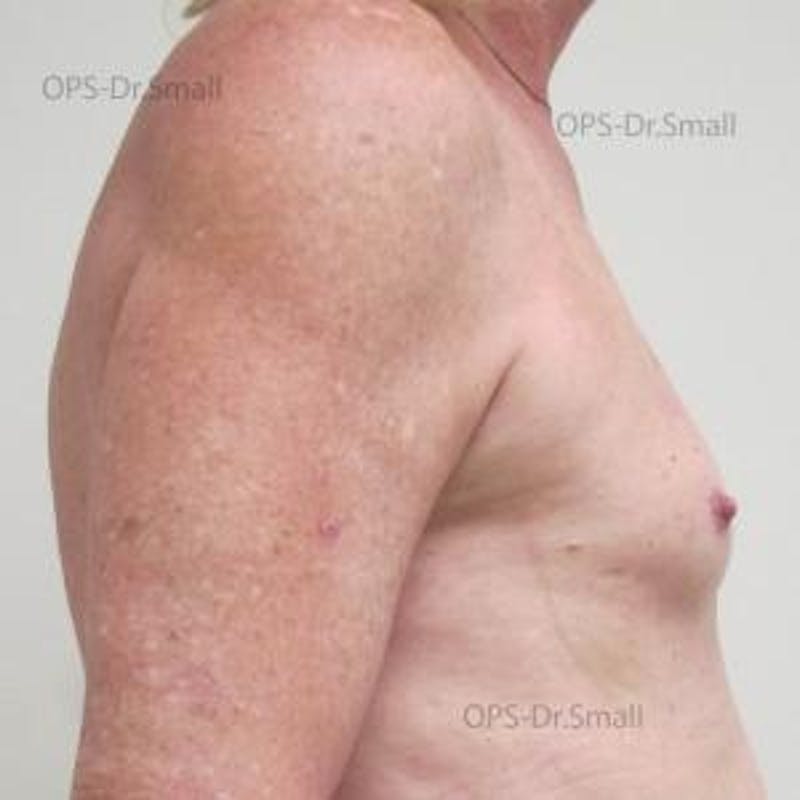 Augmentation (Enlargement) Before & After Gallery - Patient 204926 - Image 5