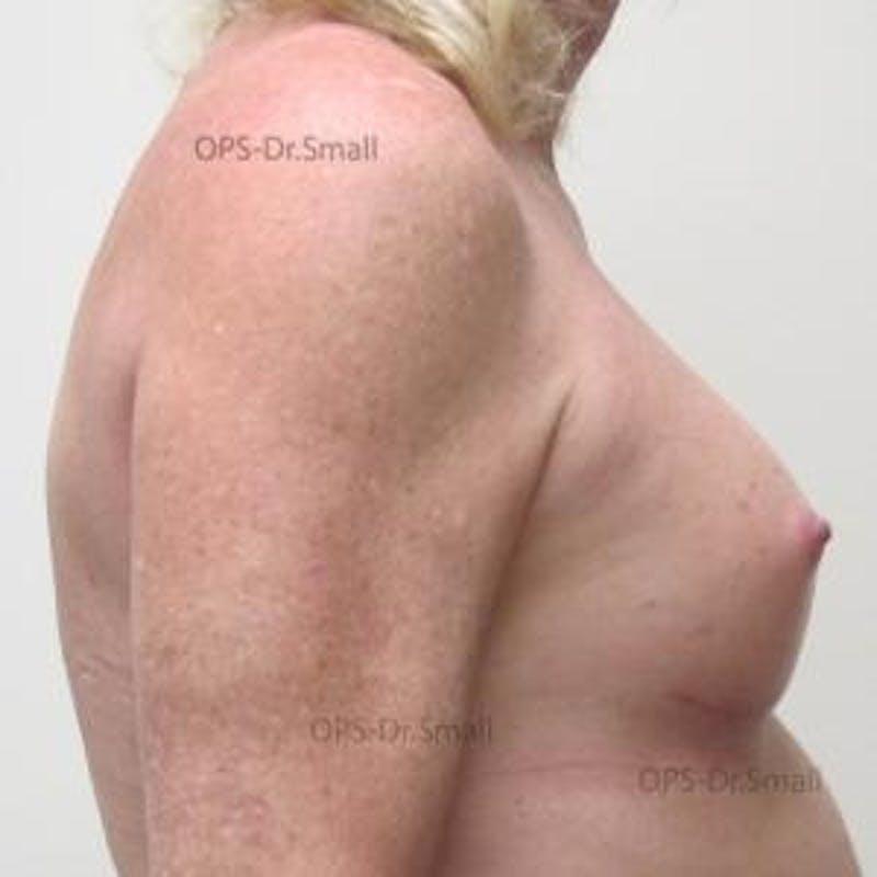 Augmentation (Enlargement) Before & After Gallery - Patient 204926 - Image 6