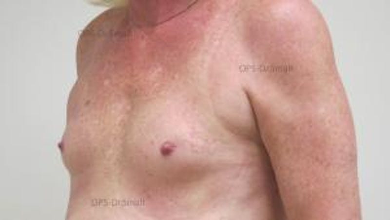 Augmentation (Enlargement) Before & After Gallery - Patient 204926 - Image 7