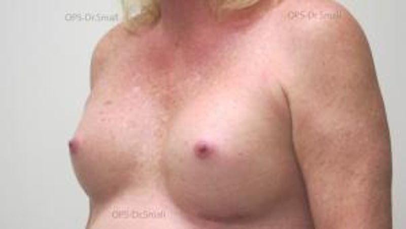 Augmentation (Enlargement) Before & After Gallery - Patient 204926 - Image 8