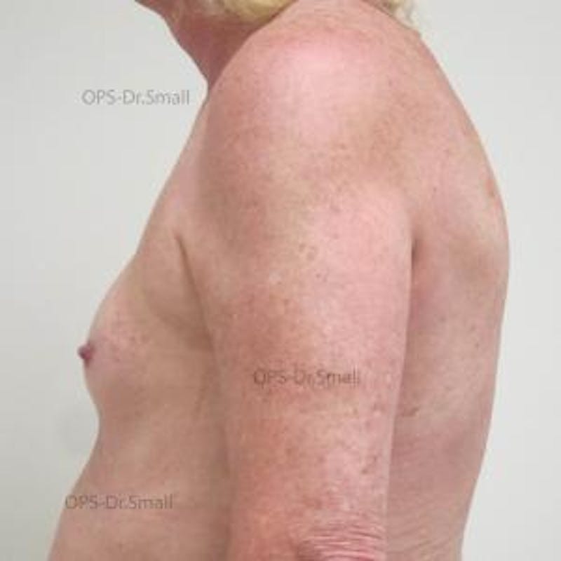 Augmentation (Enlargement) Before & After Gallery - Patient 204926 - Image 9