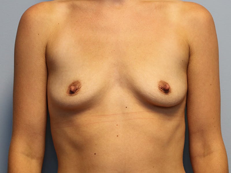 Augmentation (Enlargement) Before & After Gallery - Patient 178550 - Image 1