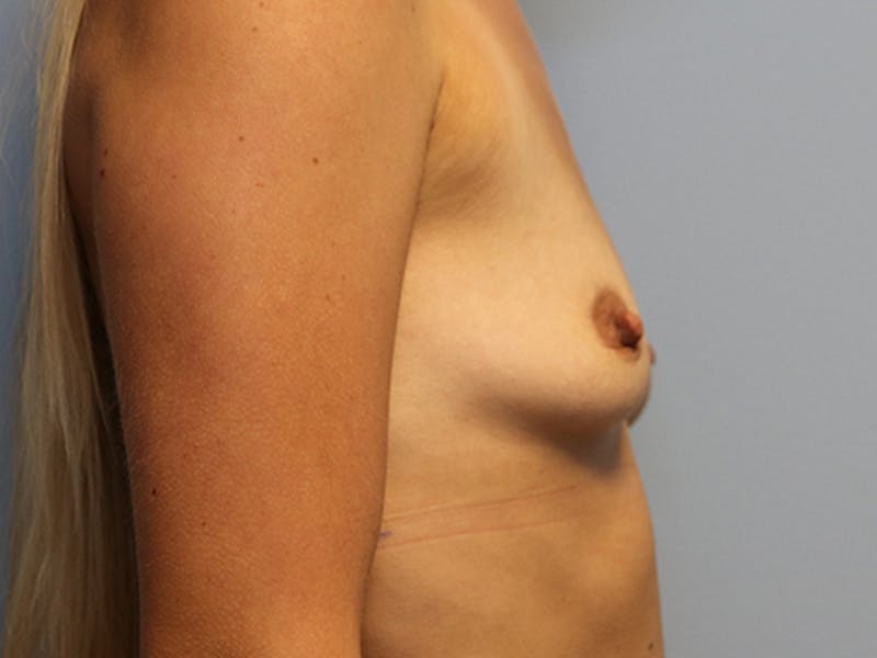 Augmentation (Enlargement) Before & After Gallery - Patient 178550 - Image 5